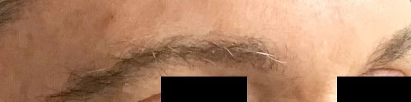 Eyebrow Transplant Before & After Gallery - Patient 218090 - Image 2
