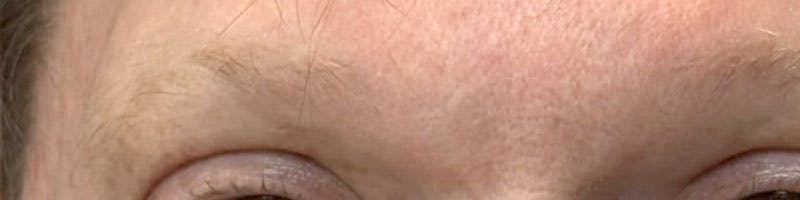 Eyebrow Transplant Before & After Gallery - Patient 259504 - Image 1