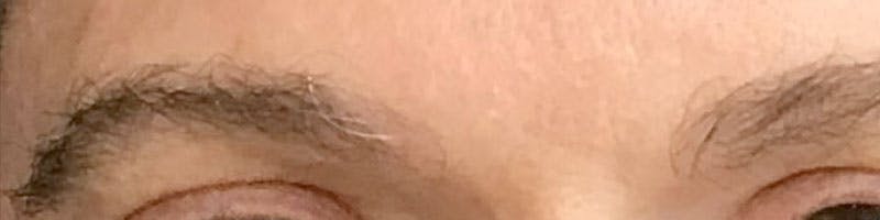 Eyebrow Transplant Before & After Gallery - Patient 259504 - Image 2