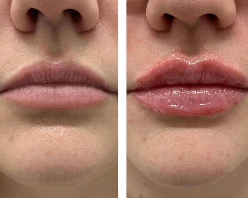 Lip Fillers vs. Lip Flip