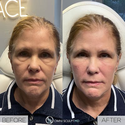 Full Facial Rejuvenation Before & After Gallery - Patient 292556 - Image 1