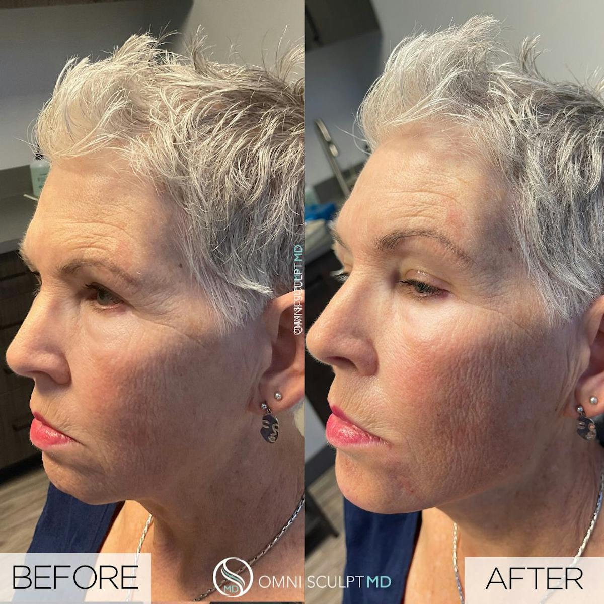 Jawline Chin Filler Before & After Gallery - Patient 151040 - Image 1