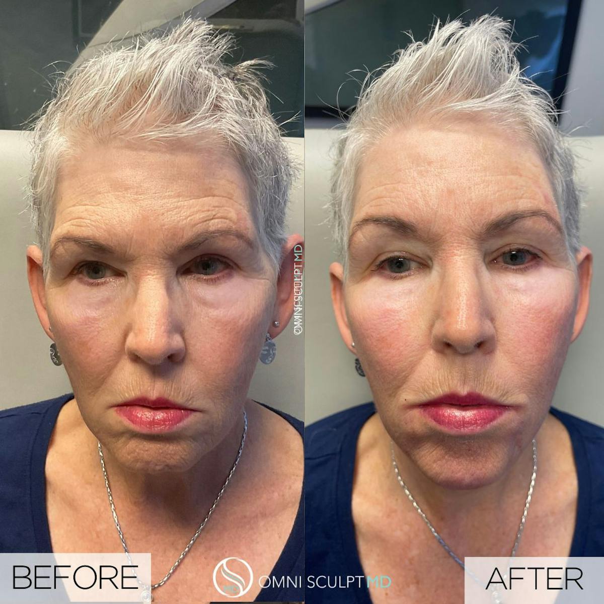 Full Facial Rejuvenation Before & After Gallery - Patient 645285 - Image 1