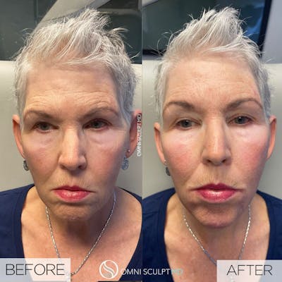 Full Facial Rejuvenation Before & After Gallery - Patient 645285 - Image 1
