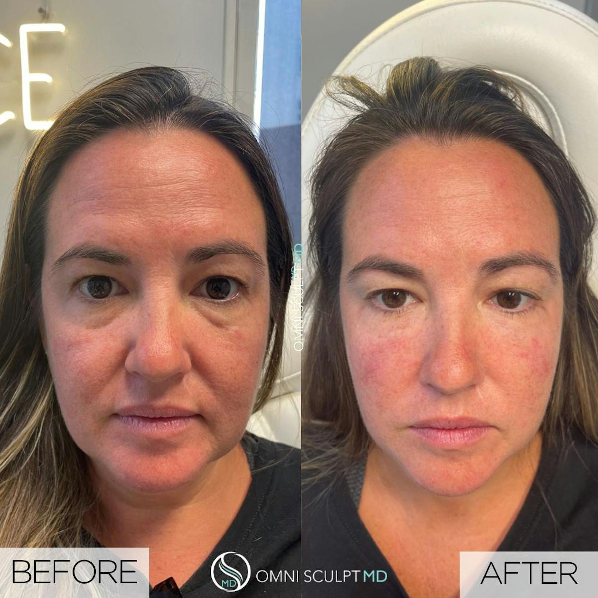 Full Facial Rejuvenation Before & After Gallery - Patient 146733 - Image 1