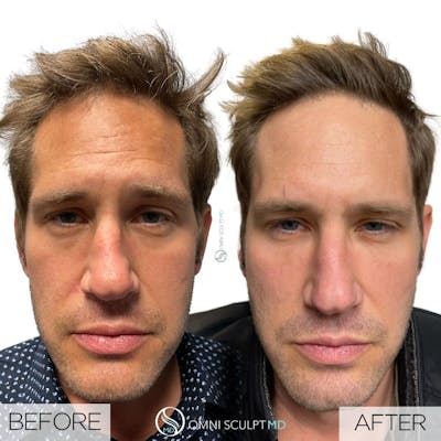 Full Facial Rejuvenation Before & After Gallery - Patient 217516 - Image 1
