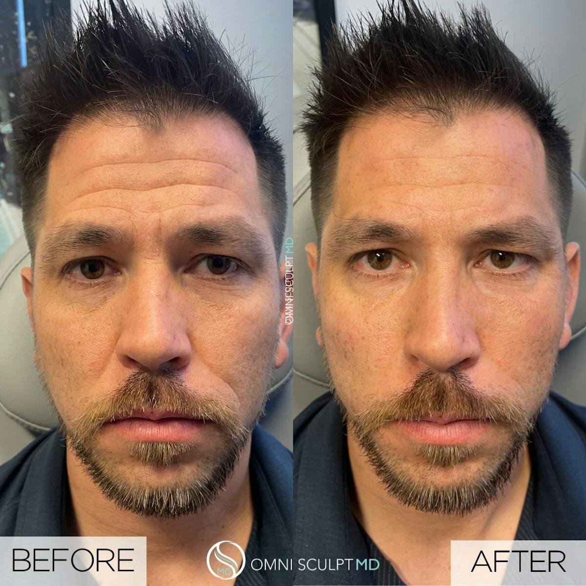 Full Facial Rejuvenation Before & After Gallery - Patient 262915 - Image 1