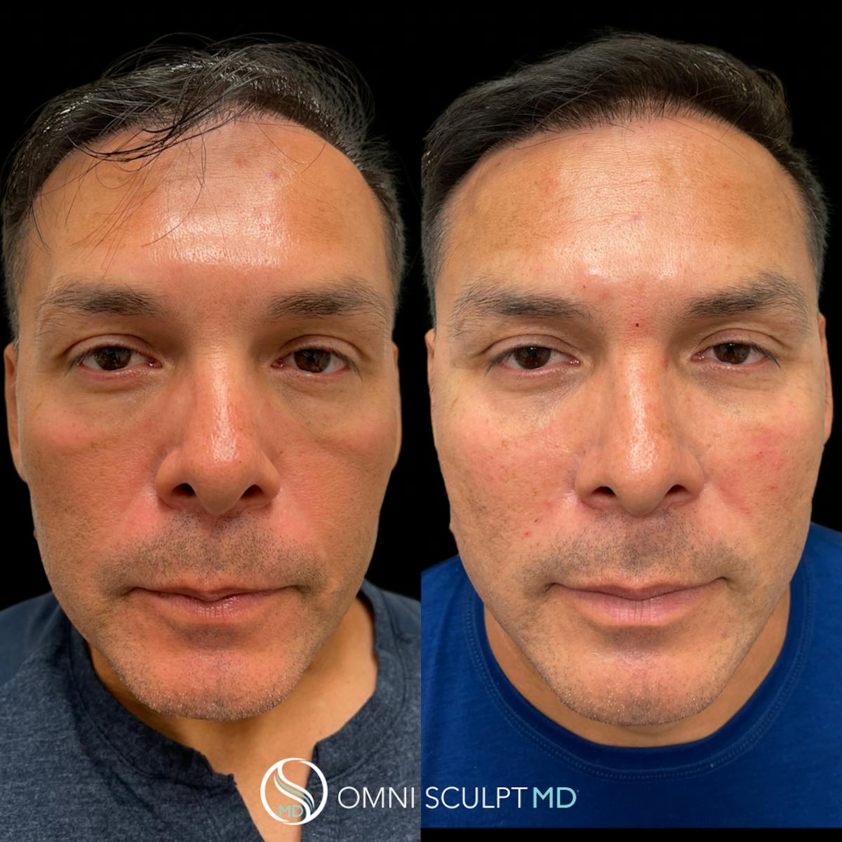 Full Facial Rejuvenation Before & After Gallery - Patient 352346 - Image 1