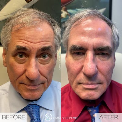 Full Facial Rejuvenation Before & After Gallery - Patient 368689 - Image 1