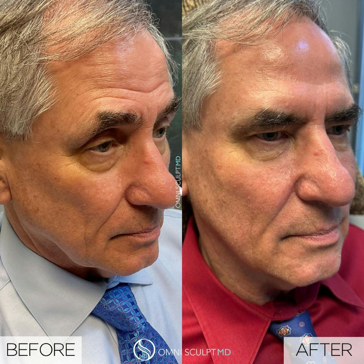 Full Facial Rejuvenation Before & After Gallery - Patient 368689 - Image 2