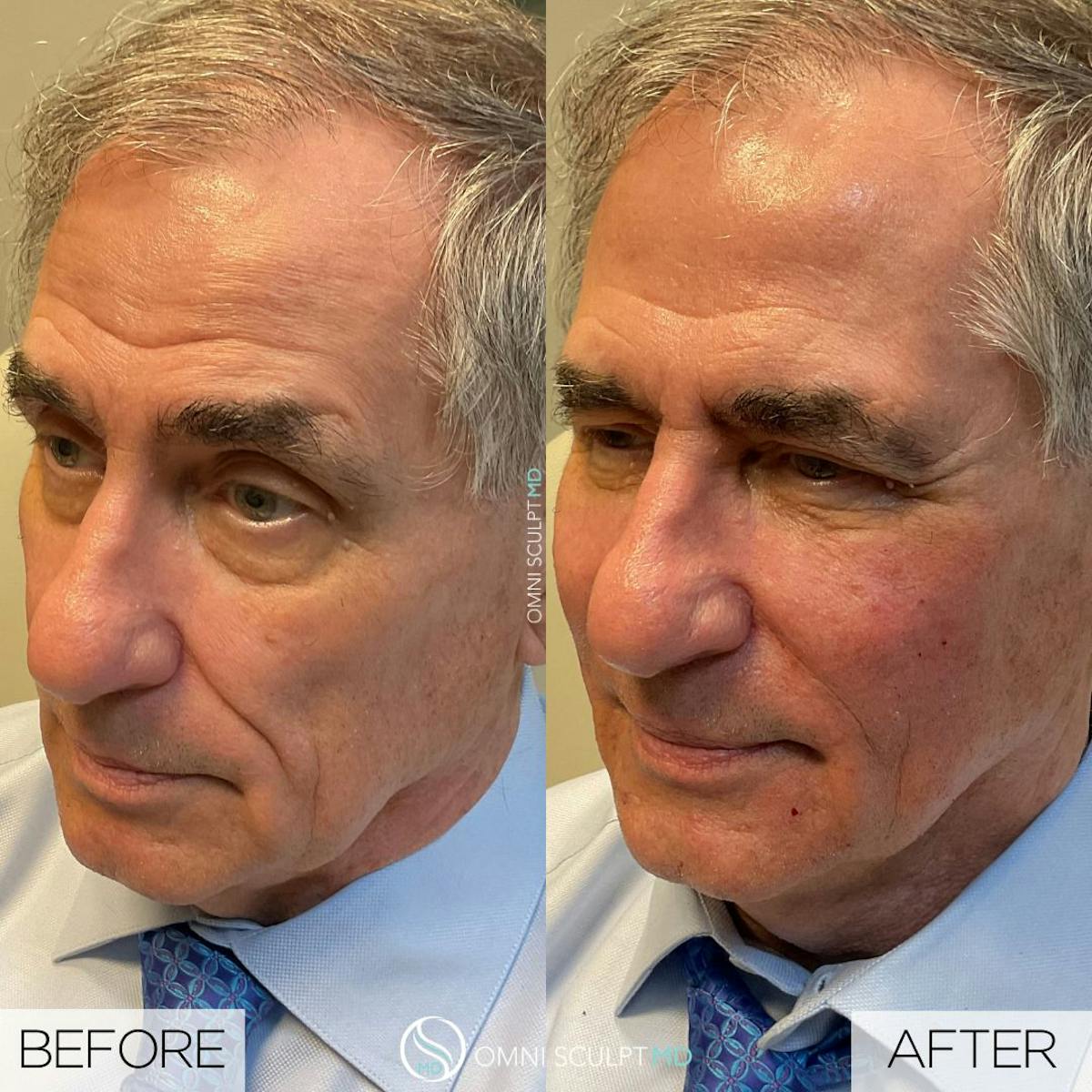Full Facial Rejuvenation Before & After Gallery - Patient 368689 - Image 3