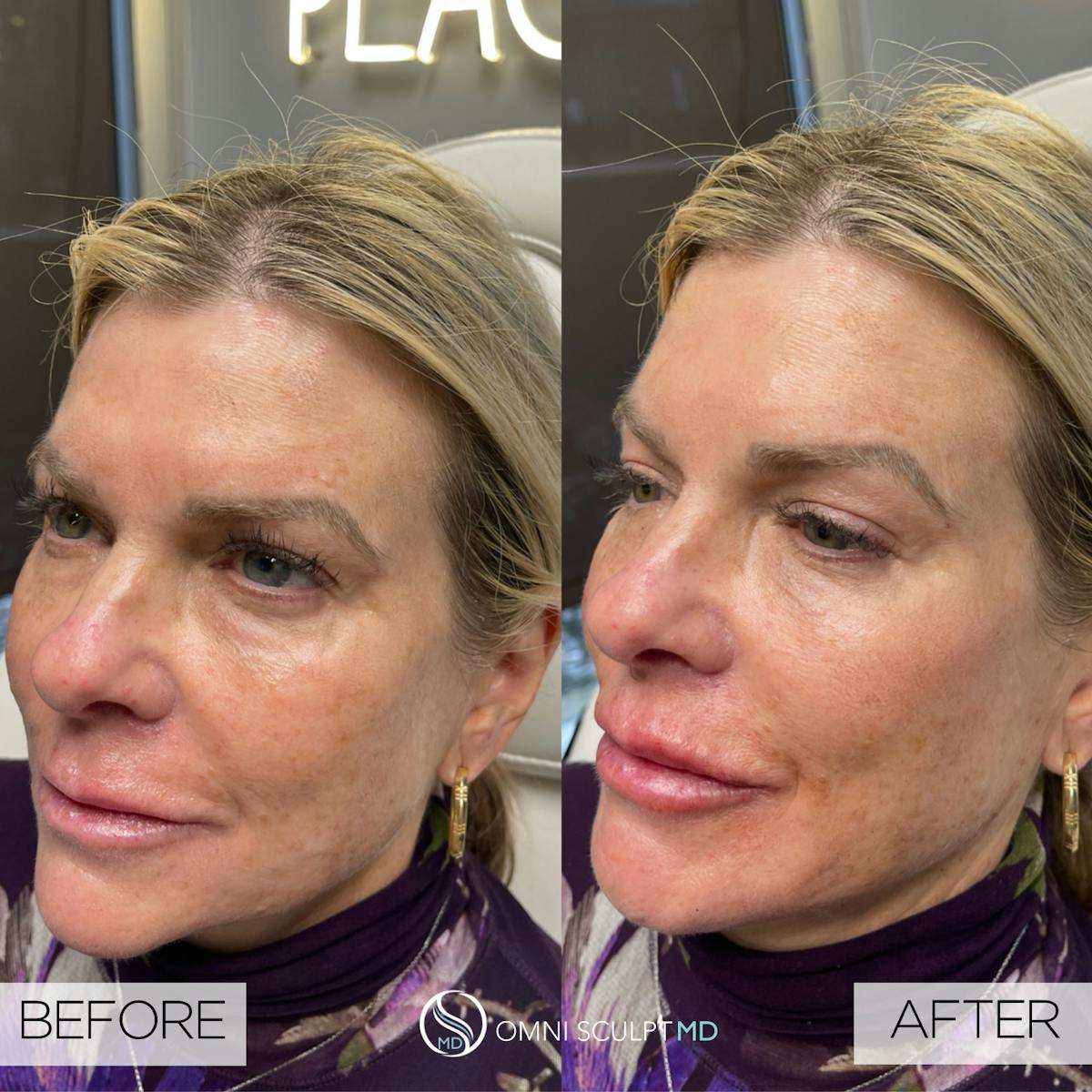Full Facial Rejuvenation Before & After Gallery - Patient 389238 - Image 1