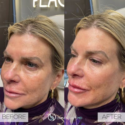 Full Facial Rejuvenation Before & After Gallery - Patient 389238 - Image 1