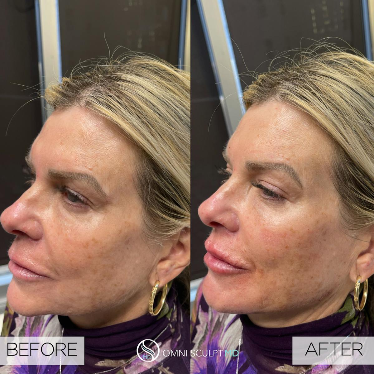 Full Facial Rejuvenation Before & After Gallery - Patient 389238 - Image 2