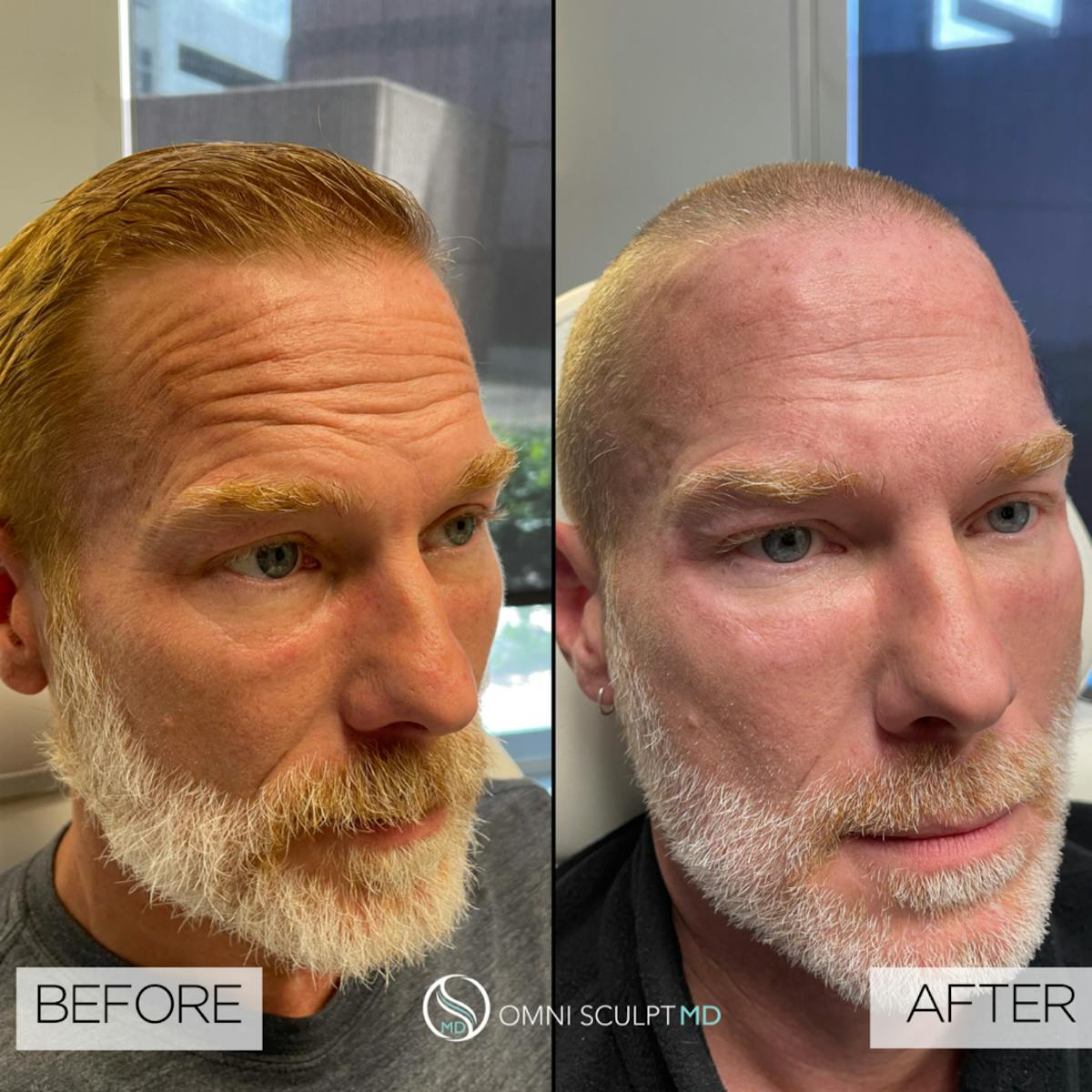 Full Facial Rejuvenation Before & After Gallery - Patient 204571 - Image 1