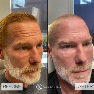 Full Facial Rejuvenation Before & After Gallery - Patient 204571 - Image 1