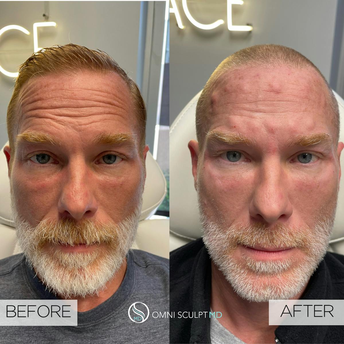 Full Facial Rejuvenation Before & After Gallery - Patient 204571 - Image 2