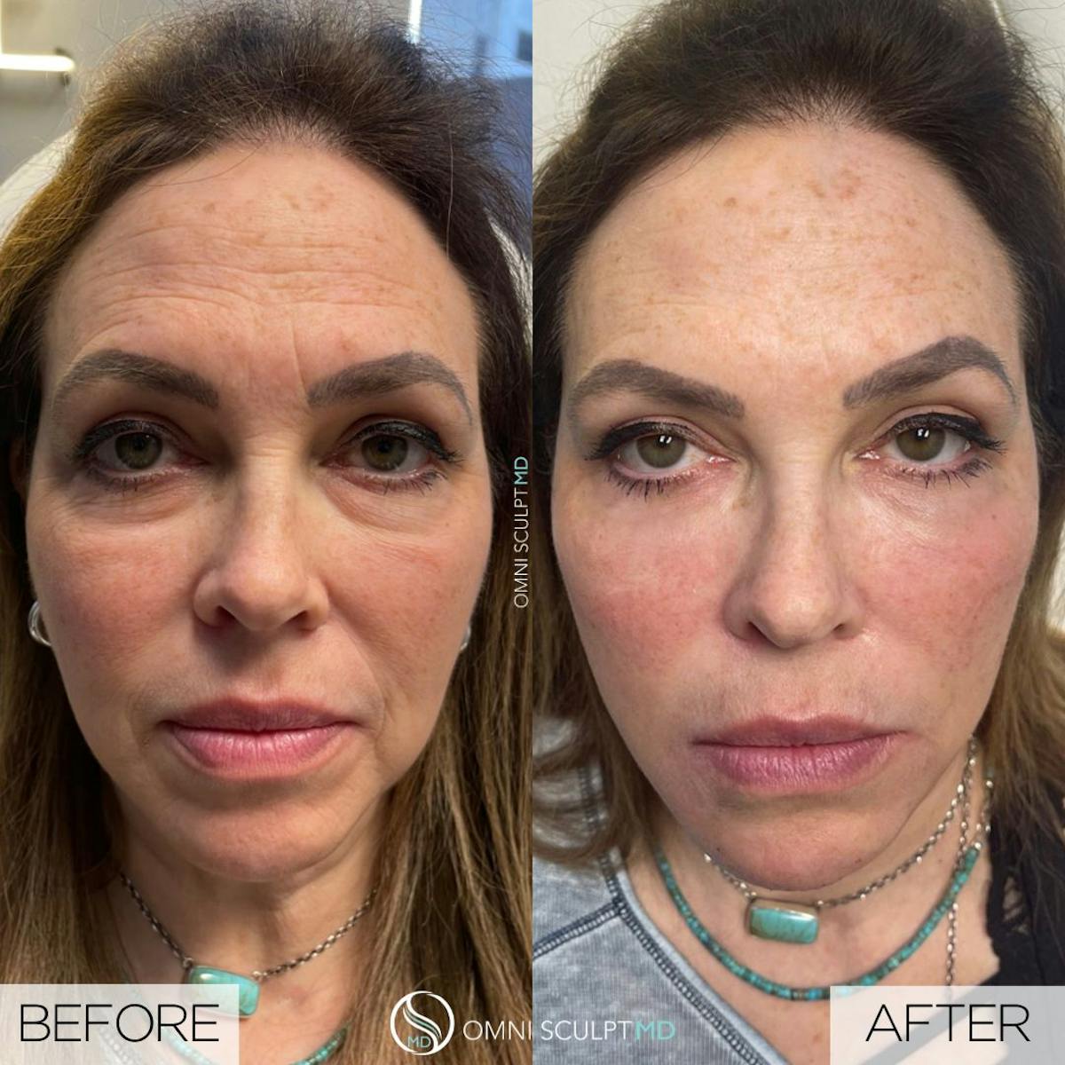 Full Facial Rejuvenation Before & After Gallery - Patient 187116 - Image 1