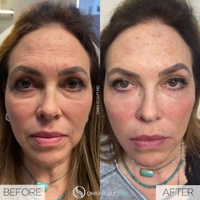 Full Facial Rejuvenation Before & After Gallery - Patient 187116 - Image 1
