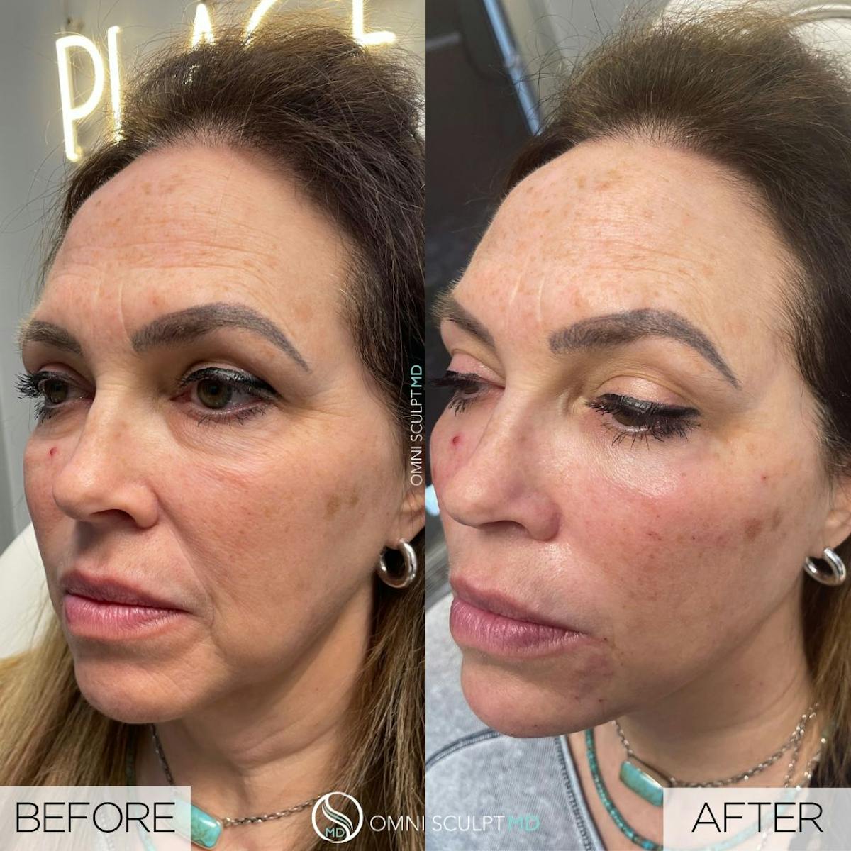 Full Facial Rejuvenation Before & After Gallery - Patient 187116 - Image 2