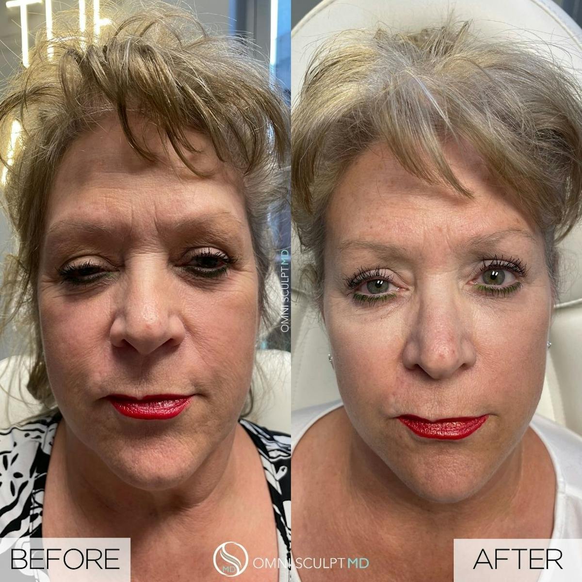 Full Facial Rejuvenation Before & After Gallery - Patient 158492 - Image 1