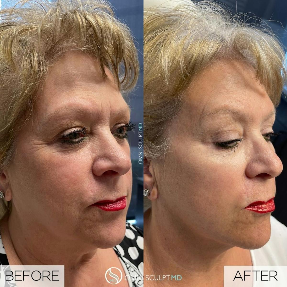 Full Facial Rejuvenation Before & After Gallery - Patient 158492 - Image 2