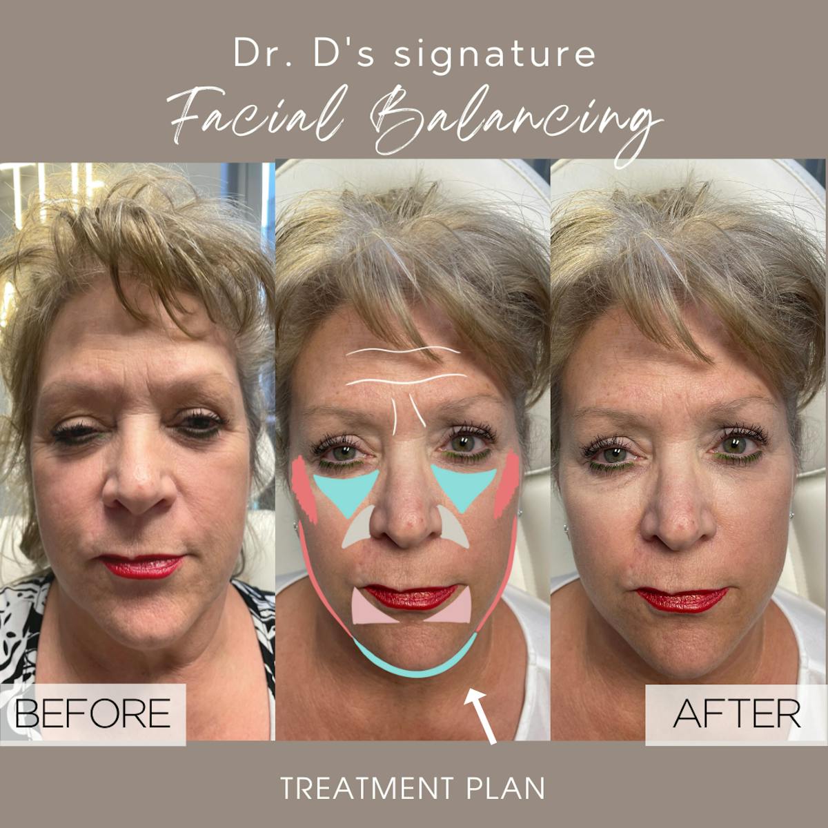 Full Facial Rejuvenation Before & After Gallery - Patient 158492 - Image 3