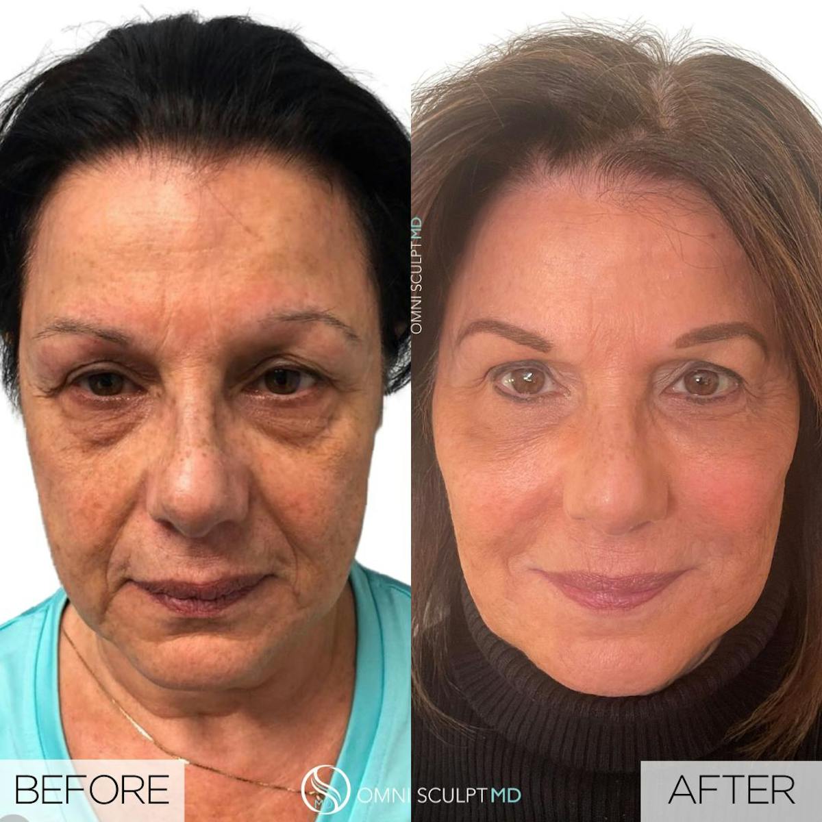 Full Facial Rejuvenation Before & After Gallery - Patient 911846 - Image 1