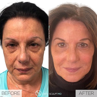 Full Facial Rejuvenation Before & After Gallery - Patient 911846 - Image 1