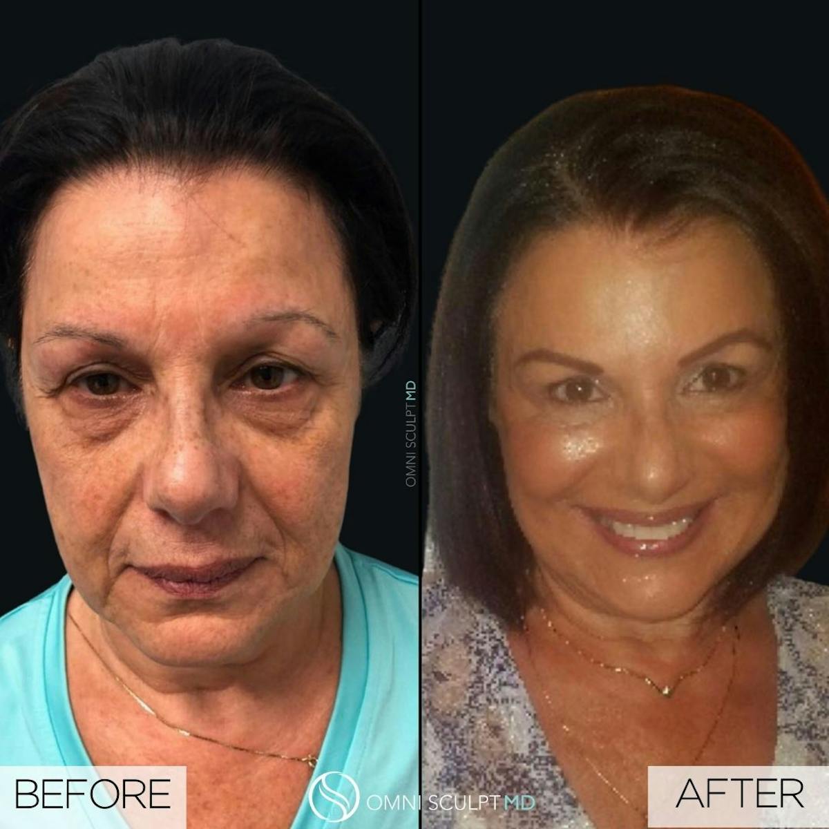 Full Facial Rejuvenation Before & After Gallery - Patient 911846 - Image 2