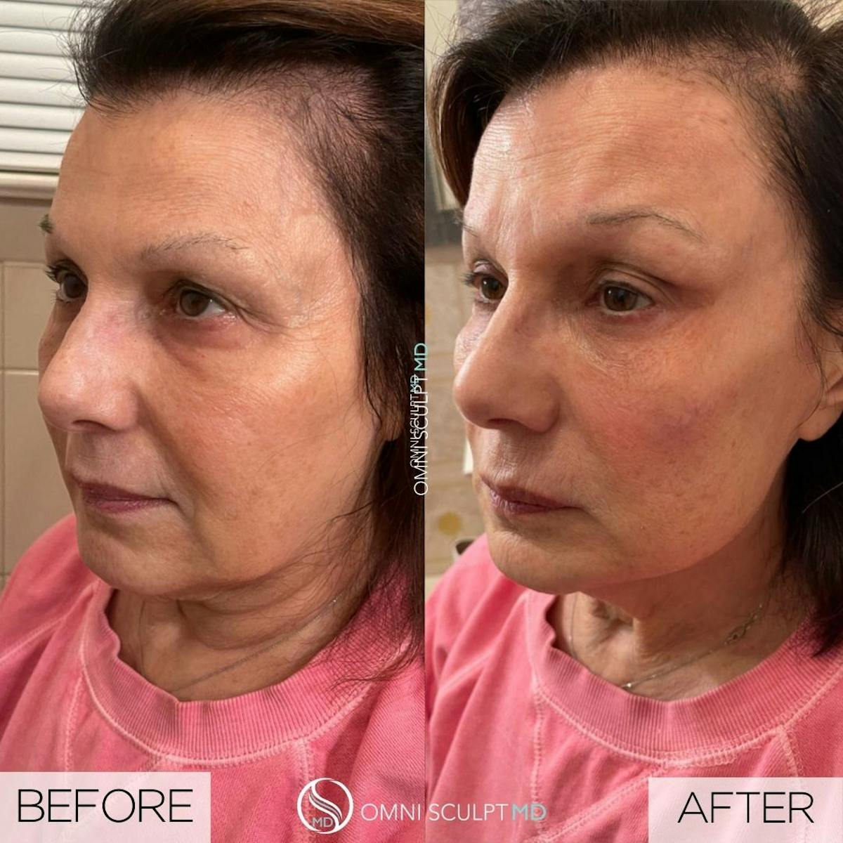 Full Facial Rejuvenation Before & After Gallery - Patient 397931 - Image 1