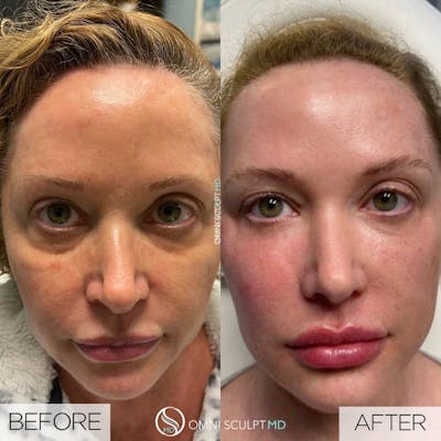 Full Facial Rejuvenation Before & After Gallery - Patient 187847 - Image 1