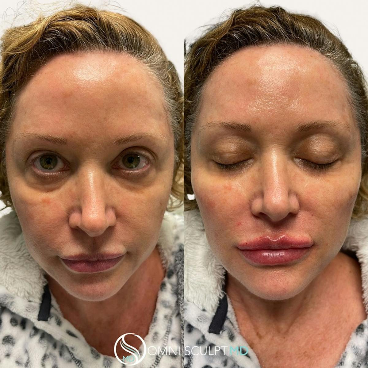 Full Facial Rejuvenation Before & After Gallery - Patient 187847 - Image 2