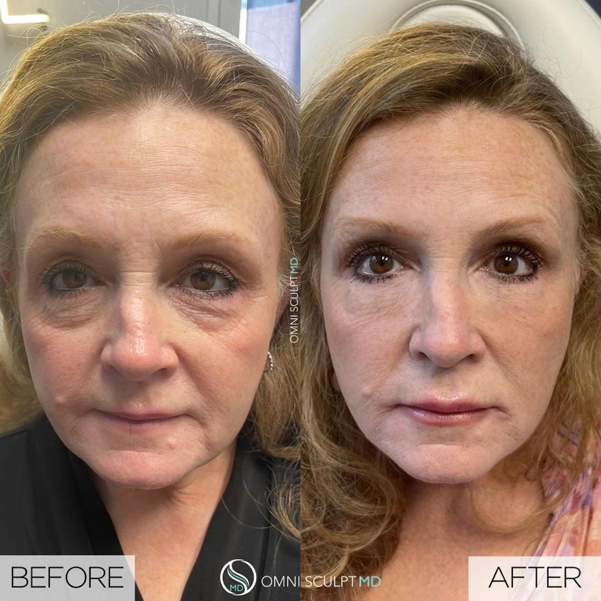 Full Facial Rejuvenation Before & After Gallery - Patient 190829 - Image 1