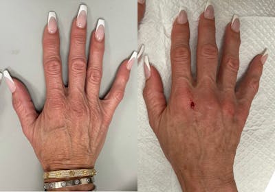 Hand Filler Before & After Gallery - Patient 201857 - Image 1