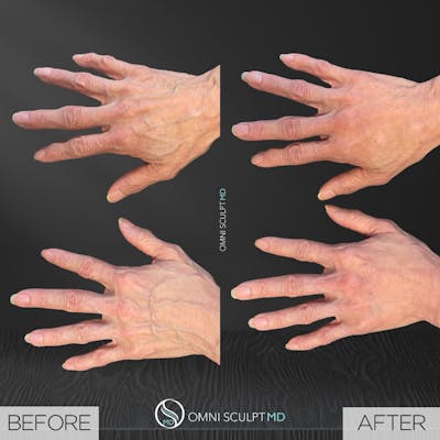 Hand Filler Before & After Gallery - Patient 642665 - Image 1