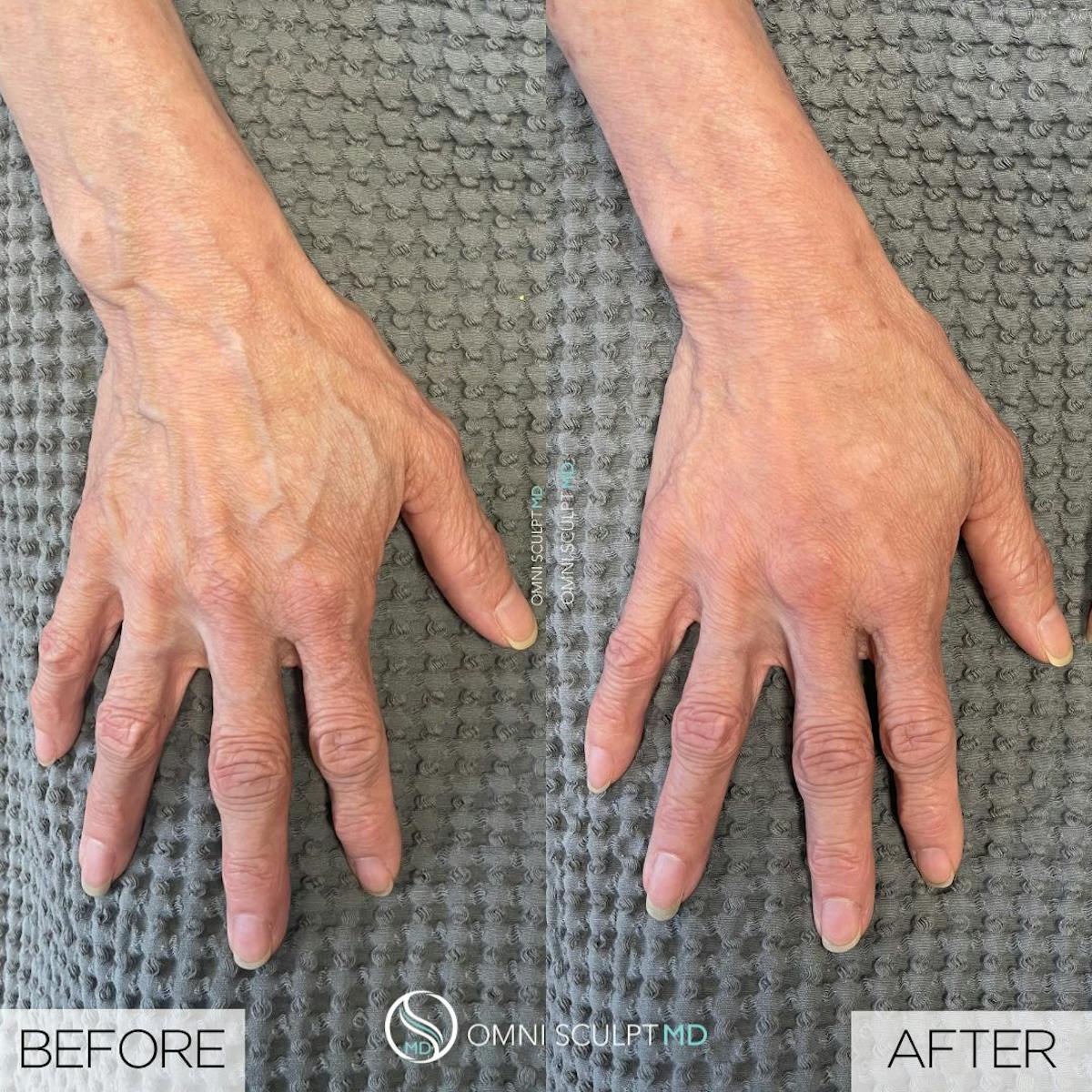 Hand Filler Before & After Gallery - Patient 133926 - Image 1