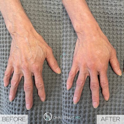 Hand Filler Before & After Gallery - Patient 133926 - Image 1