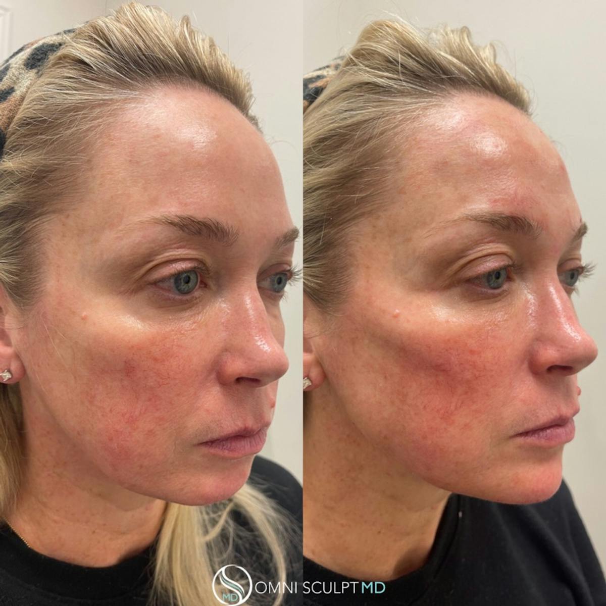 Jawline Chin Filler Before & After Gallery - Patient 819740 - Image 1