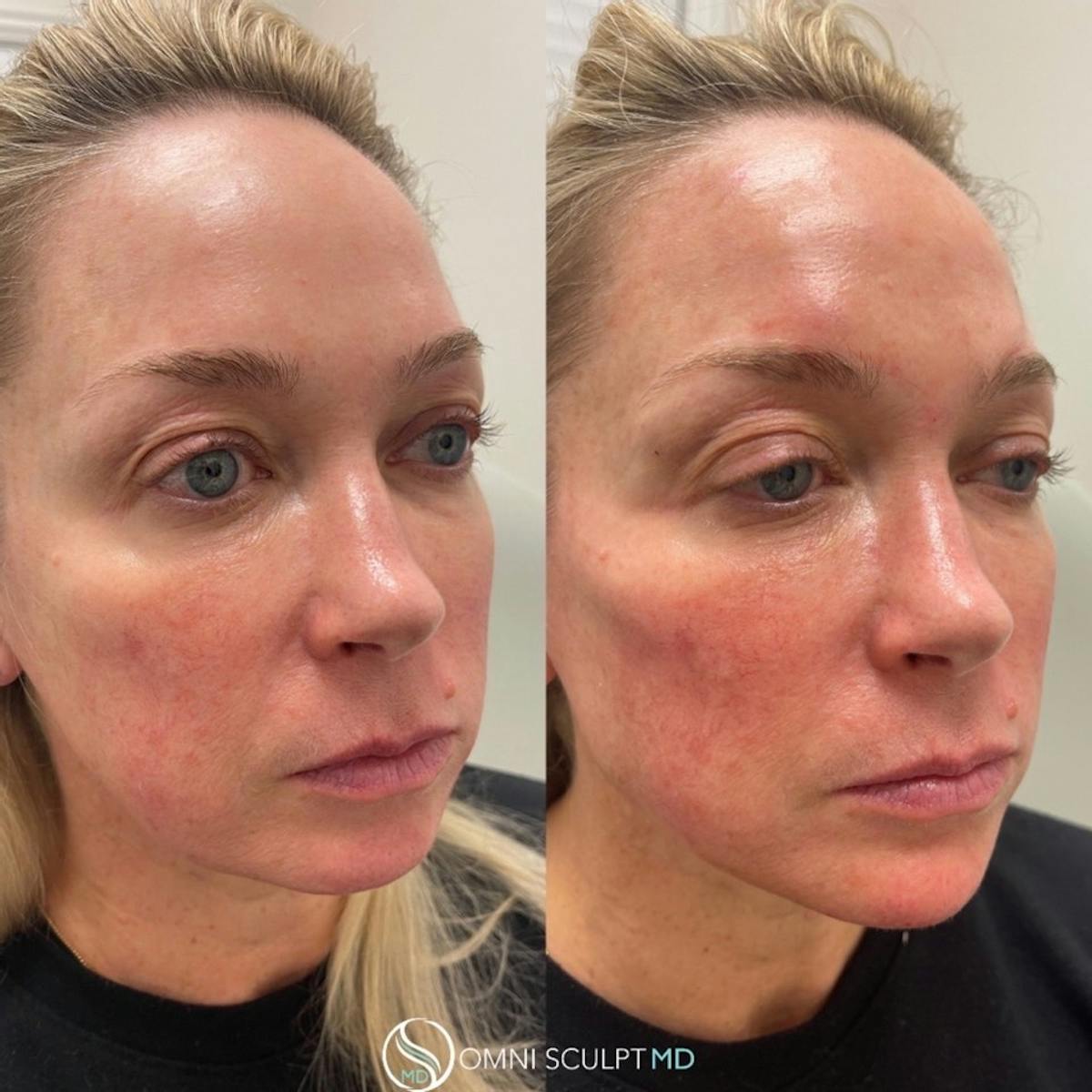 Jawline Chin Filler Before & After Gallery - Patient 819740 - Image 2