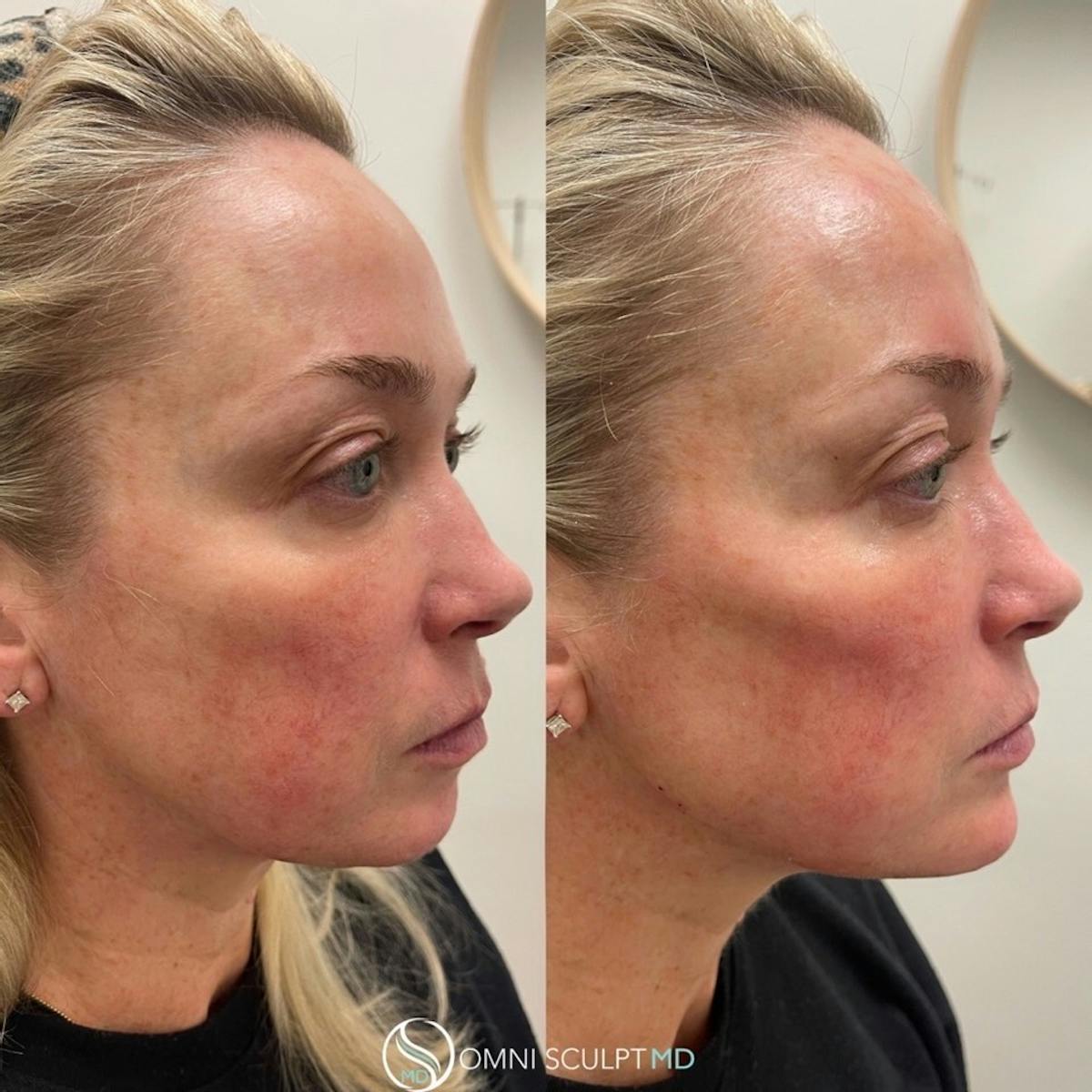 Jawline Chin Filler Before & After Gallery - Patient 819740 - Image 3