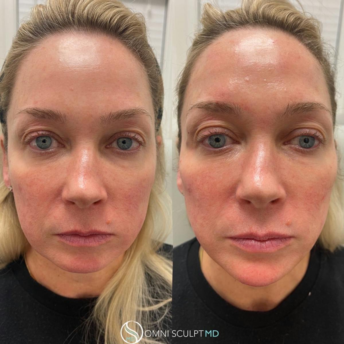 Jawline Chin Filler Before & After Gallery - Patient 819740 - Image 4