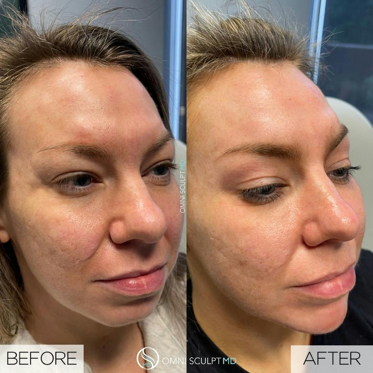 Jawline Chin Filler Before & After Gallery - Patient 196475 - Image 1