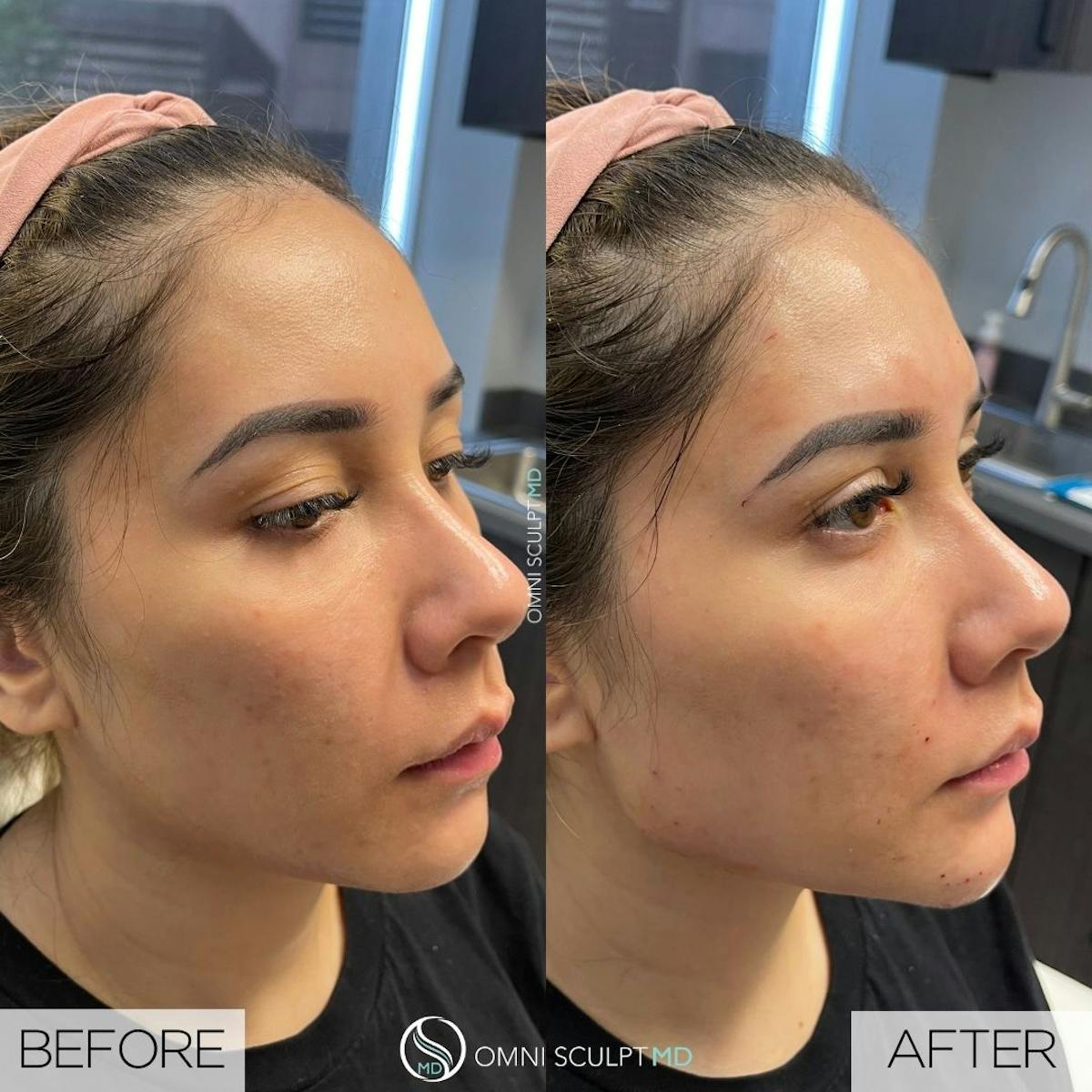 Jawline Chin Filler Before & After Gallery - Patient 654047 - Image 1