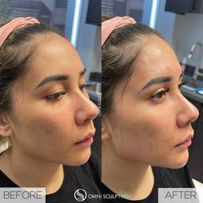 Jawline Chin Filler Before & After Gallery - Patient 654047 - Image 1