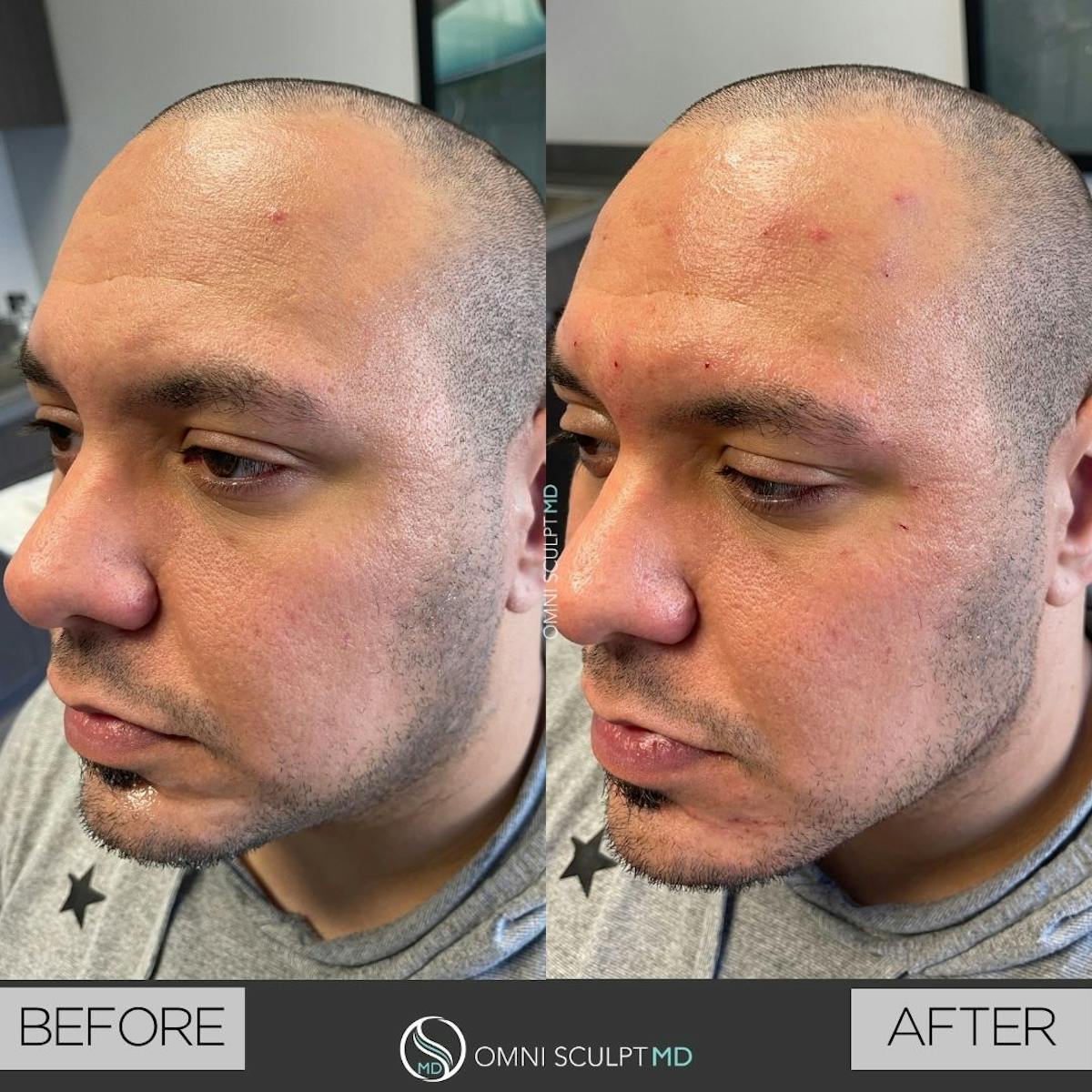 Jawline Chin Filler Before & After Gallery - Patient 110871 - Image 1