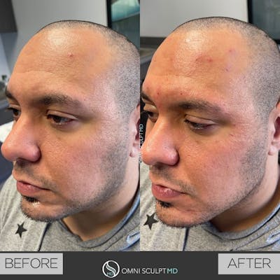 Jawline Chin Filler Before & After Gallery - Patient 110871 - Image 1