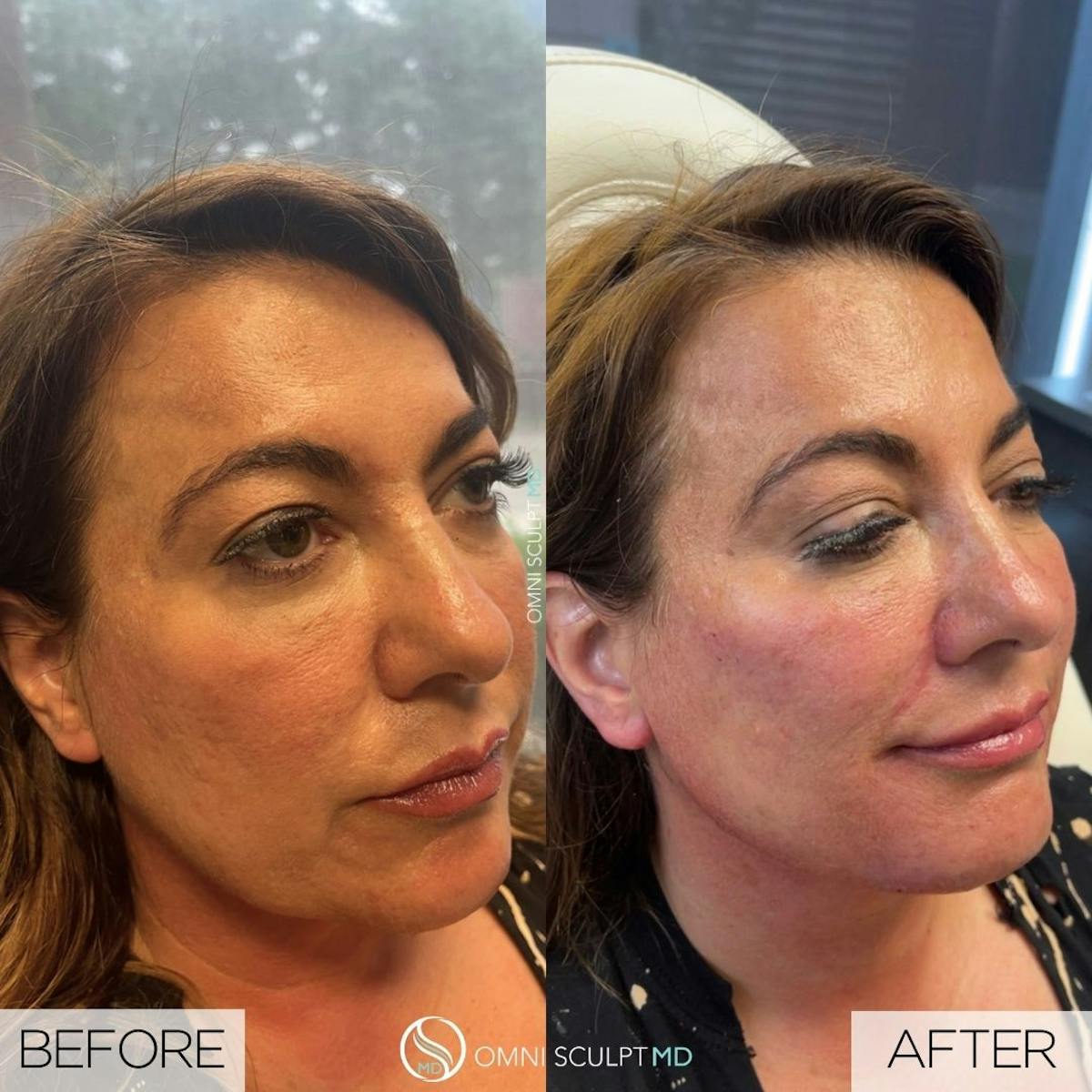 Jawline Chin Filler Before & After Gallery - Patient 145739 - Image 1