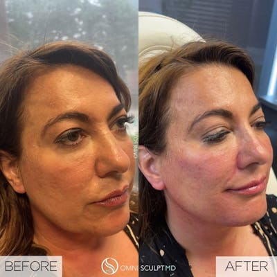 Jawline Chin Filler Before & After Gallery - Patient 145739 - Image 1