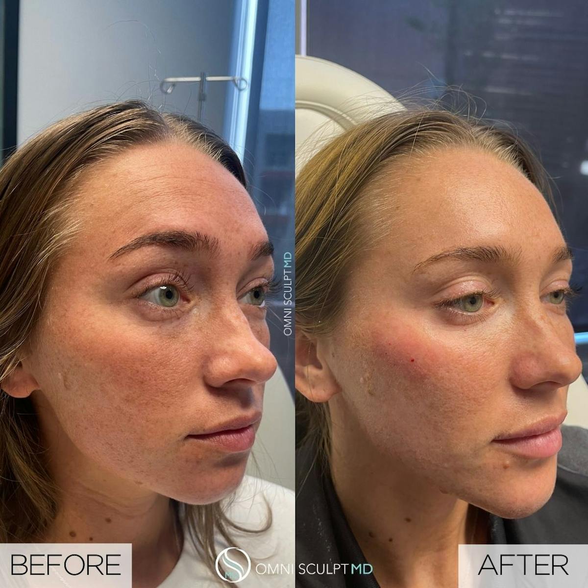 Jawline Chin Filler Before & After Gallery - Patient 151560 - Image 1